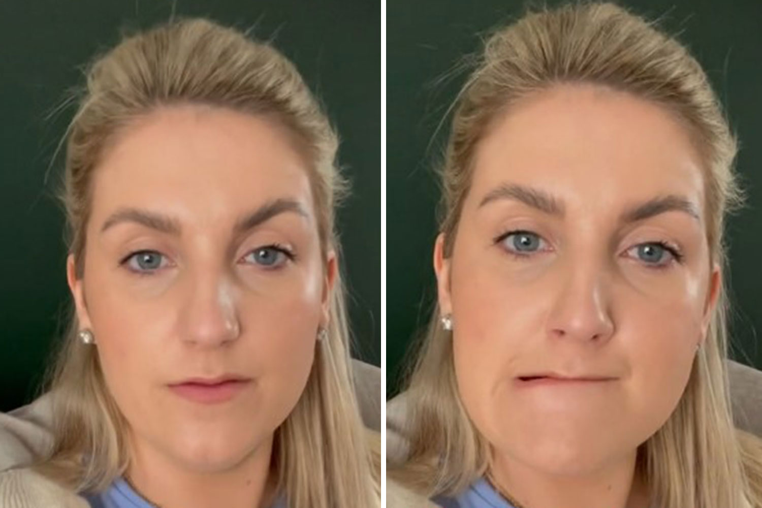 I got a lip flip with botox - no one warned me how difficult it would make life